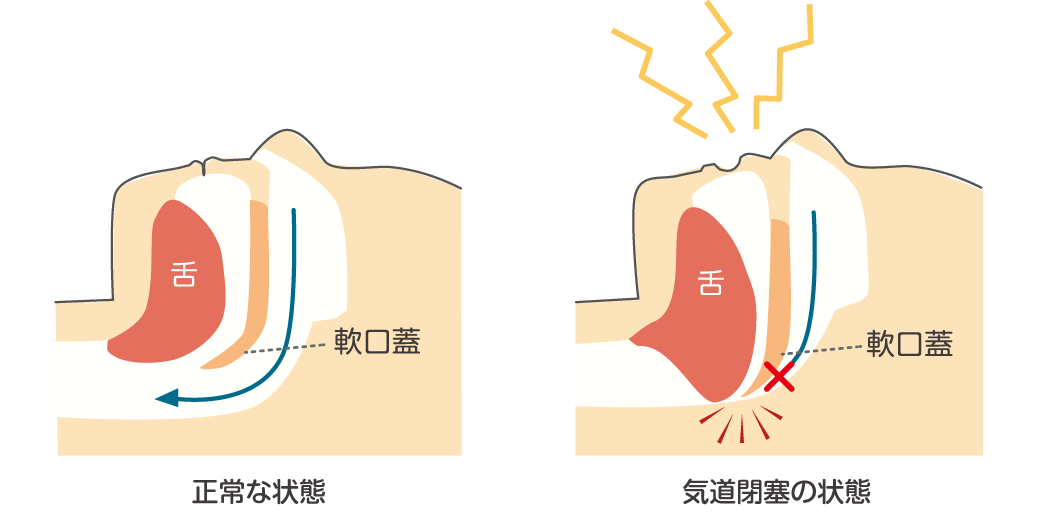 睡眠時の喉の状態